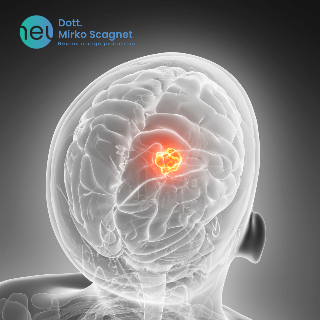 A diagnostic pitfall: atypical teratoid rhabdoid tumor versus dedifferentiated/poorly differentiated chordoma: analysis of a mono-institutional series